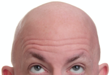 Skalli verður hugsanlega úr sögunni innan 10 ára